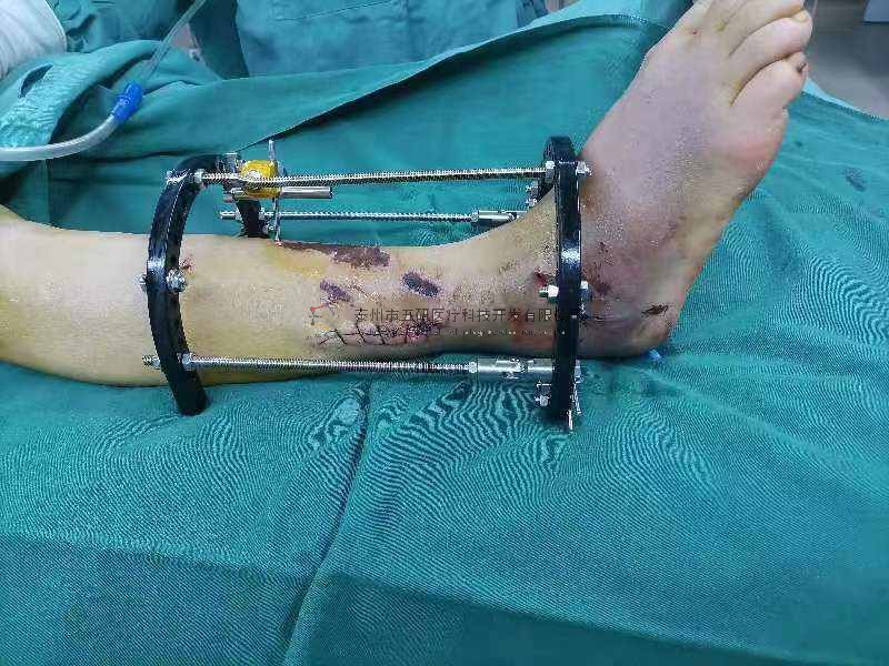 病例分享——踝關節(jié)粉碎性骨折（PILONG骨折）（糖尿病?局部皮膚條件差）