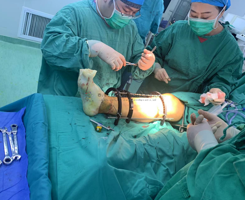 【望京醫(yī)院】不開(kāi)刀治骨折病例分享——脛骨遠(yuǎn)端骨折腓骨骨折